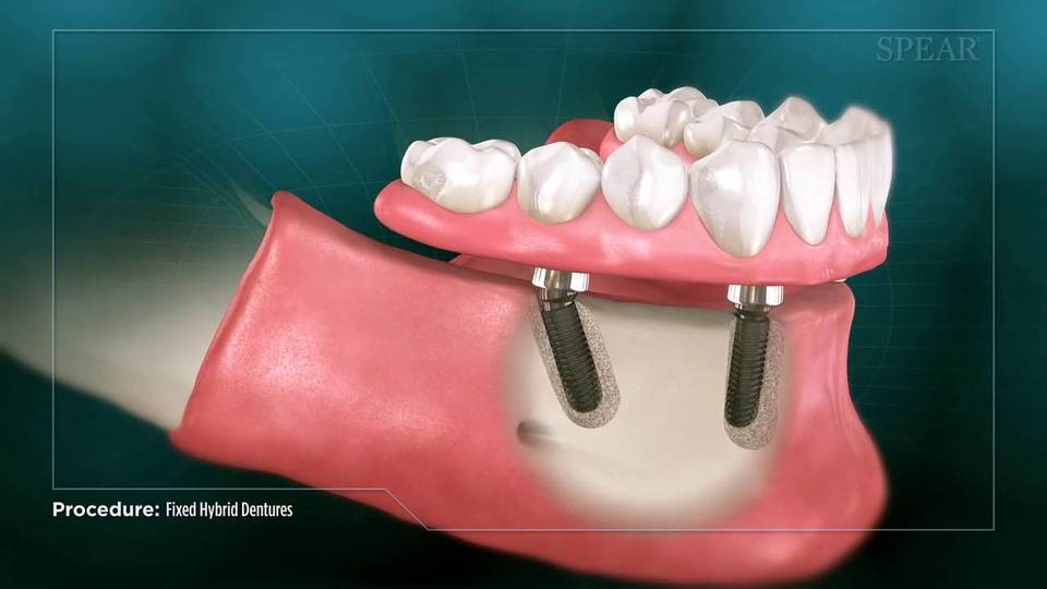 Upper Partial Dentures Oakley UT 84055